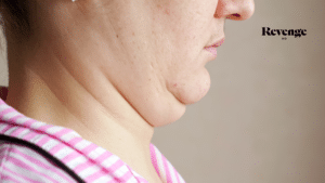 Kybella for Turkey Neck