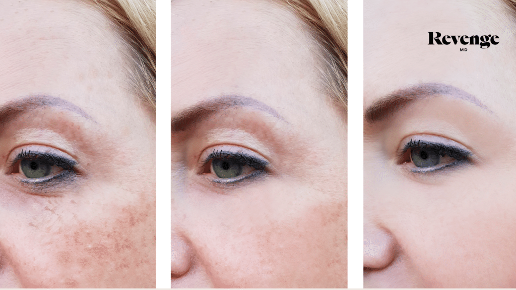 CO2 Laser Resurfacing Laser Services Before & After