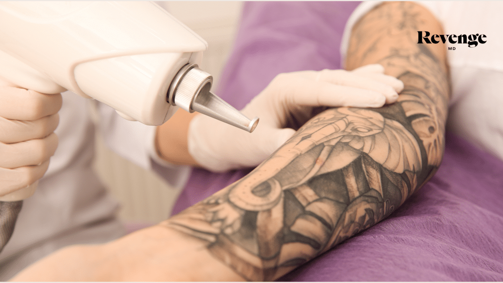 Tattoo Removal Laser Services