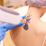 Tattoo Removal by Revenge MD in HENDERSON and LAS VEGAS