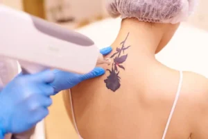 Tattoo Removal by Revenge MD in HENDERSON and LAS VEGAS