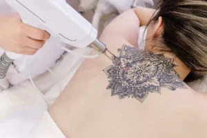 Laser Tattoo Removal in vegas nv by Revenge MD